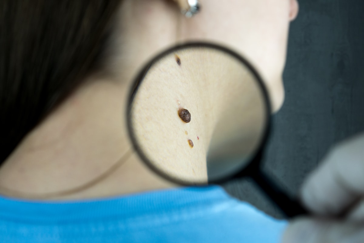 Mole & Skin Tag Removal — Enfield Royal Clinic Khalifa City